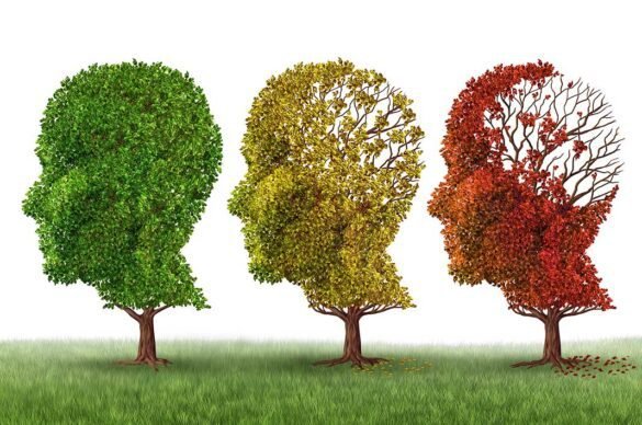 Artificial Intelligence Could Predict Alzheimer